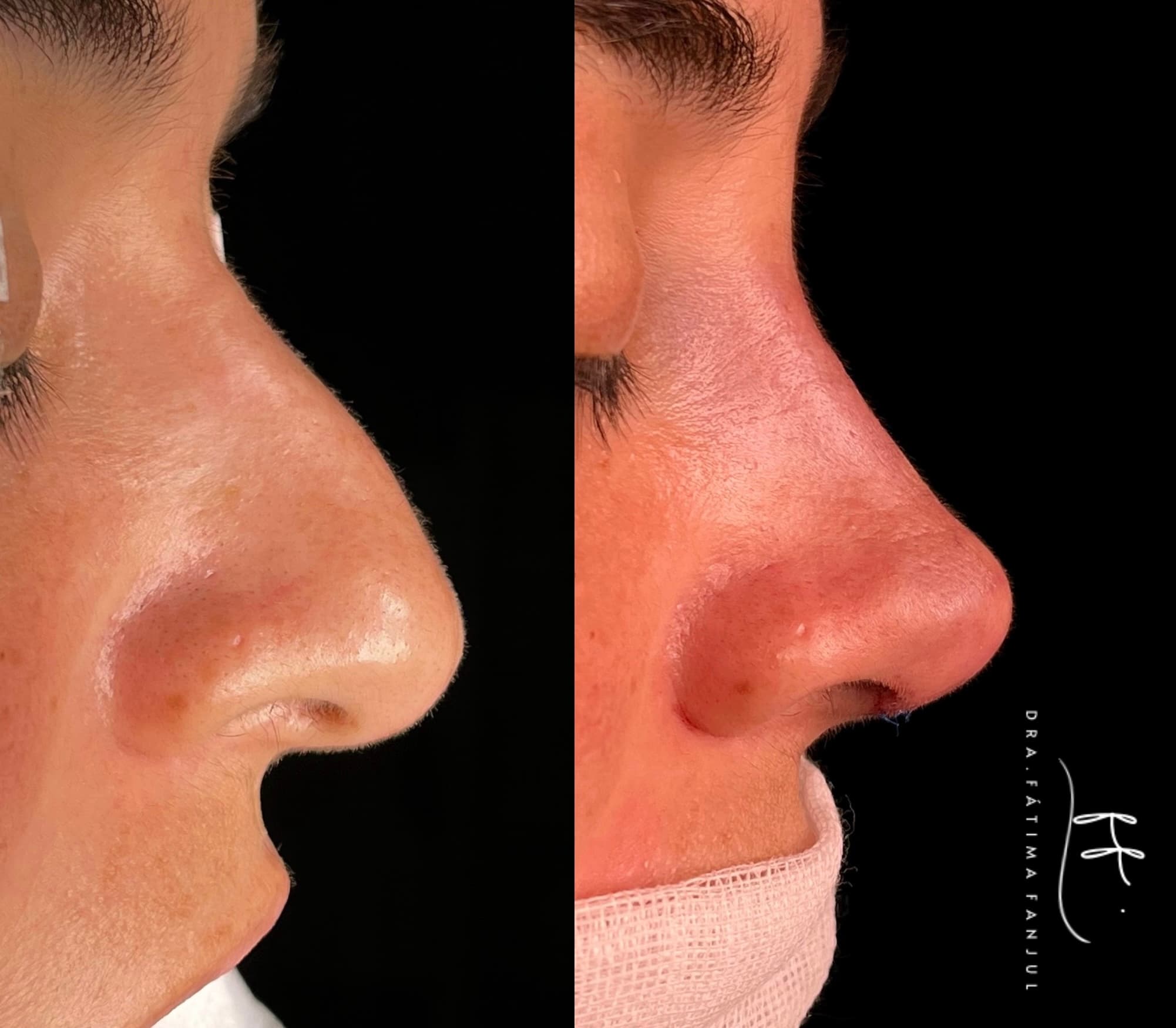 Resultado natural de rinoplastia